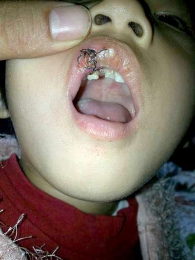 2岁女孩在幼儿园摔伤 嘴唇伤口2厘米长缝了9针
