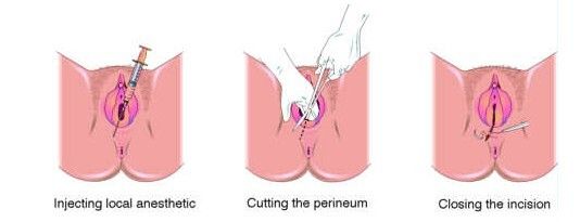 产妇分娩侧切手术全过程(图)_亲子频道_凤凰网