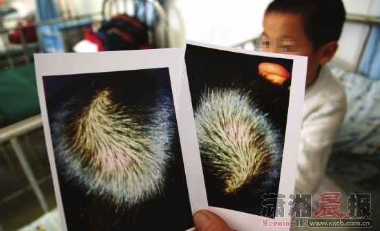1月5日，湖南省儿童医院，林林（化名）被打后拍下的照片上显示，头部有红肿并有淤血。图/IC