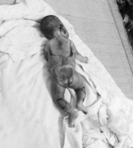 婴儿疑在医院保温箱被烤死 院方曾称死于感染