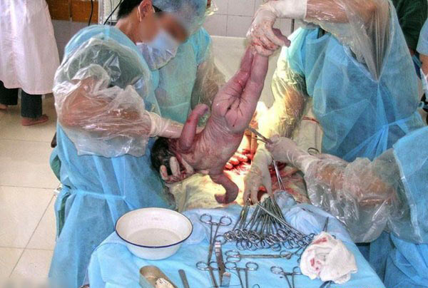 最新剖腹产手术全过程现场实拍组图