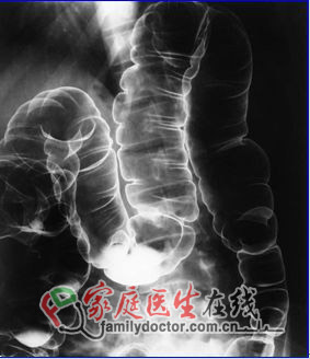 胸部X线检查能查哪些病 全面分析X线作用(图)