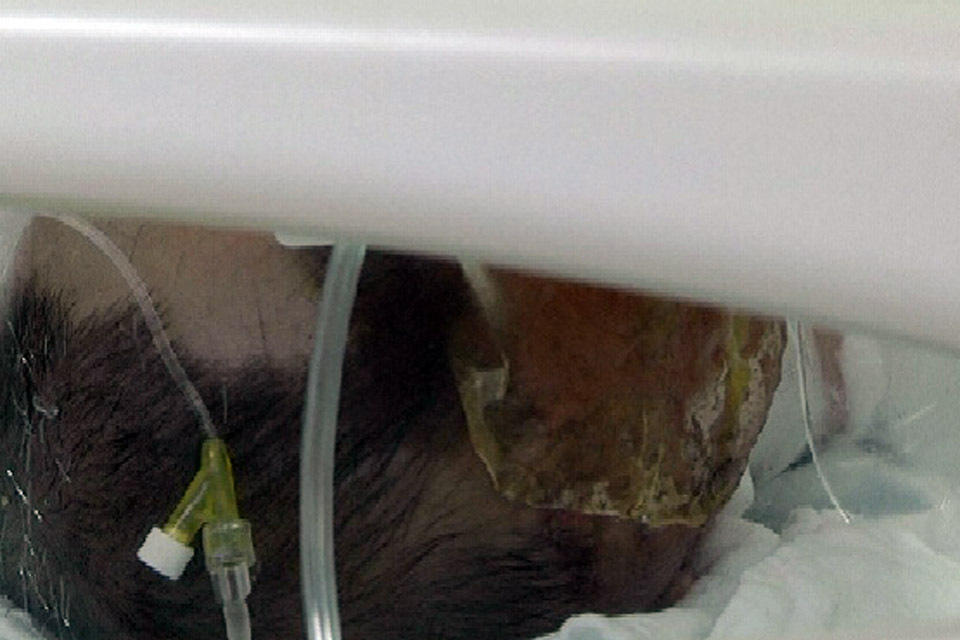 肇庆一7个月大婴儿头部撞入煲里 被热粥烫伤(