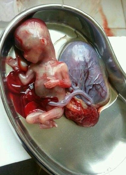 血淋漓的堕胎照片 看了你还忍心堕胎吗?