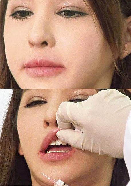 港女星为整成“舒淇唇”连打14针(图)