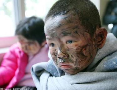 湛江氢气球爆炸多人被灼伤成黑脸 系老人抽烟所致_厦门频道_凤凰网