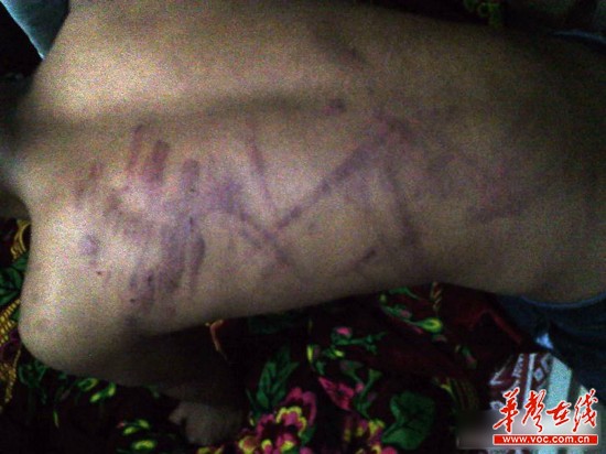 网曝云南省富源县一名老师持续4小时体罚学生，期间打断5根电线。（图为被体罚学生）网络截图