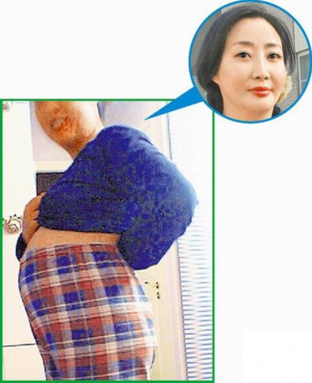 Yuki昨午在微博放上因误诊导致后遗症的大肚照