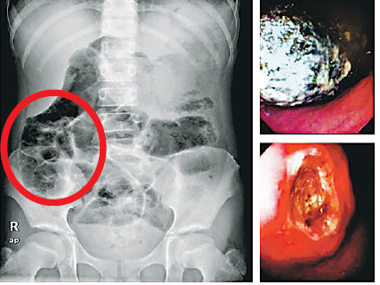 长度约有16厘米,引致胃溃疡