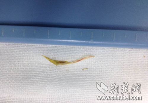 武汉男子吃鱼太快致十二指肠被鱼刺扎穿