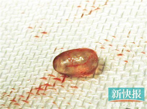奥美定变异成小颗粒如鱼卵一般,密密麻麻分布于乳房各个组织中,包括浅