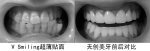 宝威体育下载网站：宝威体育官网：不磨牙零创伤牙齿美容掀起“无创”潮流