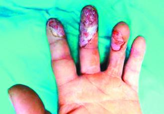 台湾男子回收废品时误碰化骨水 险些截肢|确