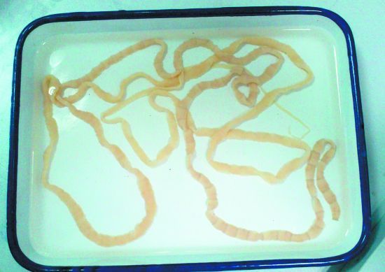 女子吃带血丝牛排 体内长出2.5米长绦虫(图)|医