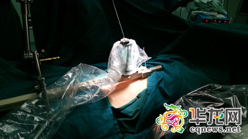 手术机器人正在对伤者进行手术定位。新桥医院供图 华龙网发