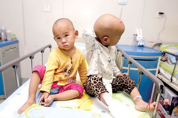 两个孩子剃光头准备手术。