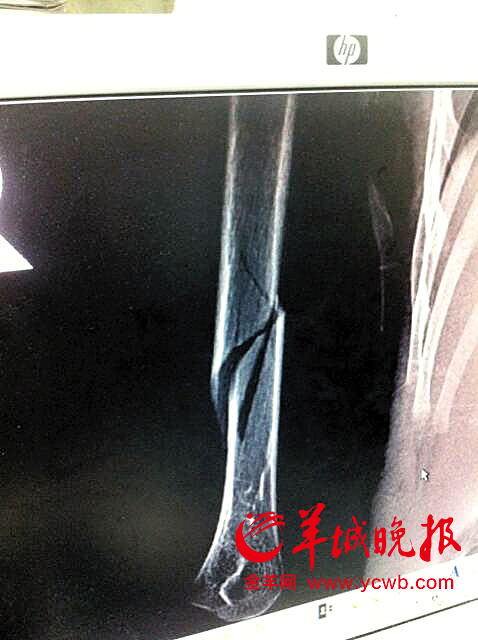 　　男童骨折照片