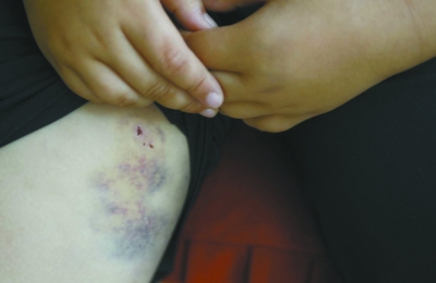 被父亲打过的地方一片淤青