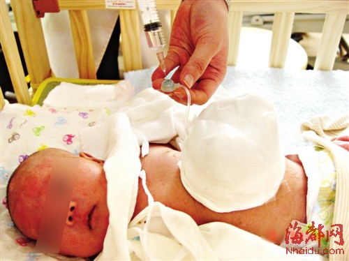 医生在Joy肚皮上接了一个人工贮袋和水袋，并往水袋里打入生理盐水，利用水的重量将器官一点点压回肚里