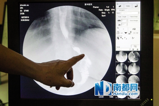 9月27日早上,小周磊在做胃餐,通过医生的显示器可以看到术后小胖胃的大小。