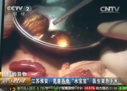 儿童玩具水宝宝属三无产品 男孩吞食后被切肠