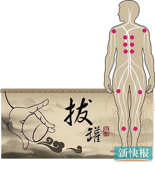 虽然夏季气温高,可广州气候仍脱不了湿字,很多人有疲倦乏力、腰酸腿软或肩膊酸痛的感觉。中医专家指出,这些都是湿邪困阻体表经络而致,拔罐可通经活络、行气活血、消肿止痛、祛风散寒等,简便有效。很多人自己拔罐,但如果没有经过专业培训,很容易造成伤害。 新快报记者 梁瑜 通讯员 陈瑶璇 DIY拔罐选真空抽气罐更安全,但不能走罐 李伯的女儿在网上为老爸买了一套抽气罐,建议老爸平常自己拔拔罐。李伯尝试了一次,掌握不了程度,差点把背后的皮肤弄破!