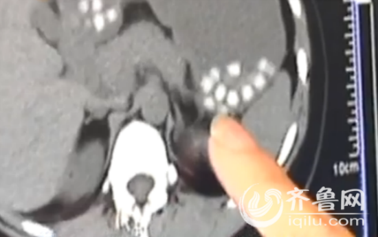 看起来香软可口的珍珠，经过一番咀嚼，到了胃里在CT的照射下仍然粒粒饱满清晰可见。(视频截图)