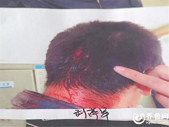 高密转业军人擒贼搏斗中头部受伤 缝六针追回