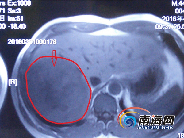 CT可见肝部巨大占位。通讯员 张献怀 摄