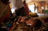Zara Mahamat经受着营养不良的折磨，腹泻并发着高烧。她由妈妈陪伴着，在重症监护帐篷接受鼻饲治疗。

