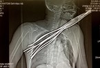 男子被七根钢筋穿透 治疗后高位截瘫