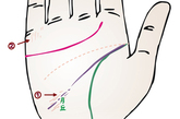 膀胱炎智慧线斜走月丘，中有断口，并带模糊的细小杂线，多是膀胱结石。尾指根处现出多条短纵线，多是膀胱疾患。
