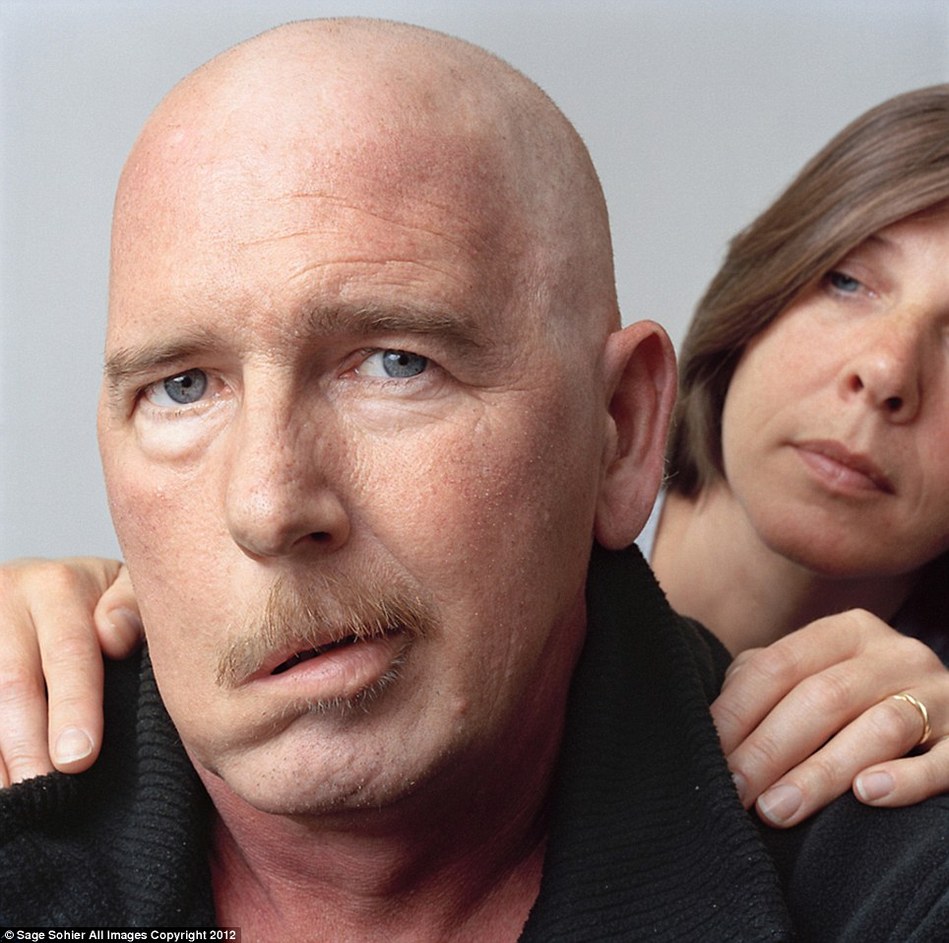 摄影师镜头呈现面瘫病人脸部表情