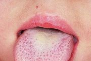 看舌苔知道患有哪些病症(图)