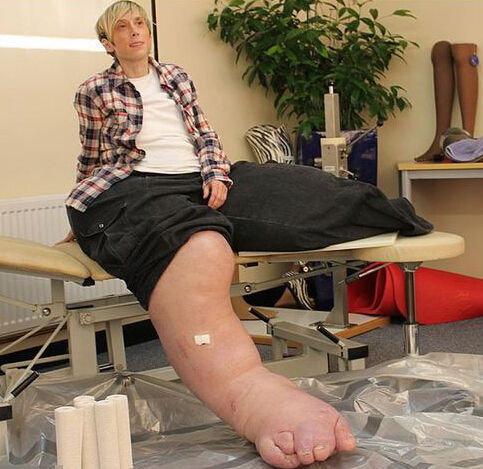 英女子患巨腿症双腿重达108公斤