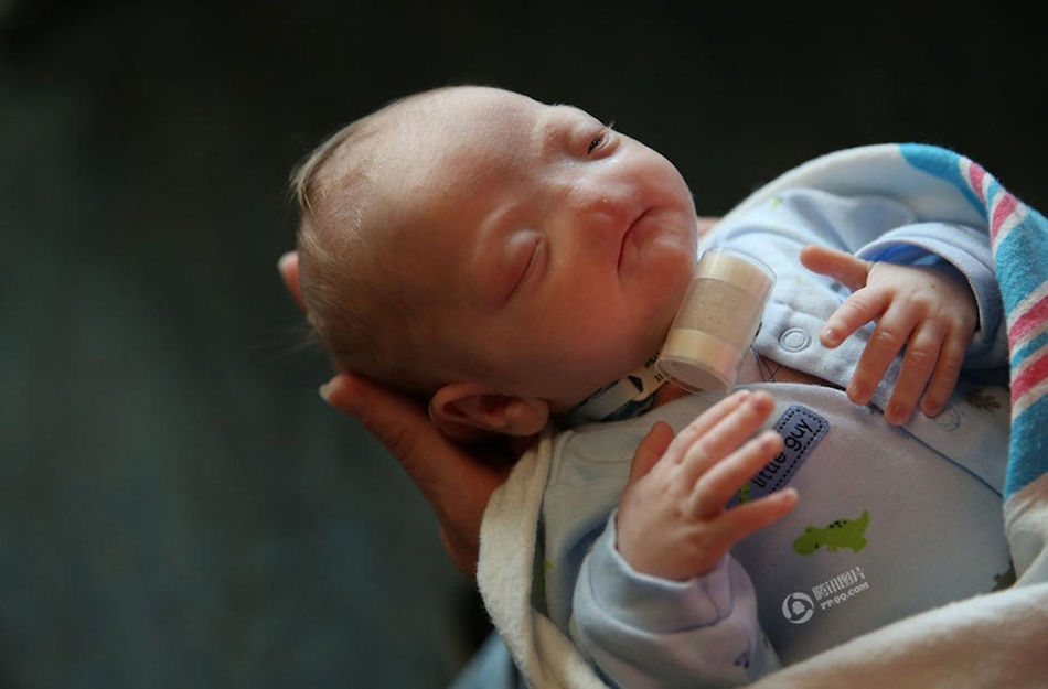 美国男婴天生没有鼻子 概率近两亿分之一
