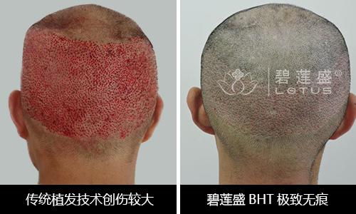 碧莲盛BHT无痕植发技术将参加世界植发大会展示