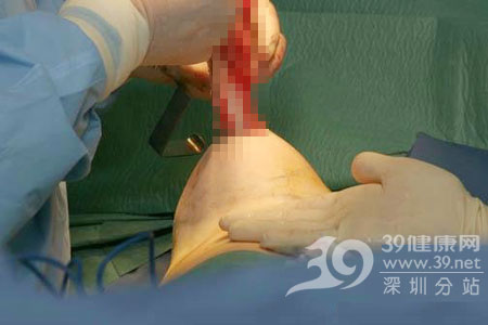 手术室实拍隆胸手术全过程(图)