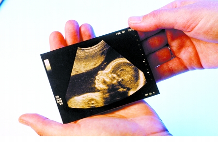 b超数据预知胎儿性别