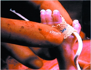 全球首例娘胎内肺部手术成功