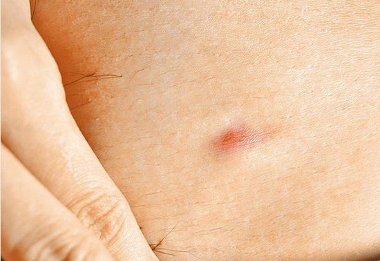 高雄女子腹部冒丘疹2年 查出是恶性肿瘤(图)