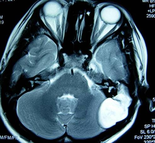 <em>山西</em>医科大学第一医院成功清除先天巨大乳突胆