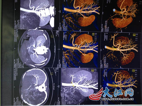 腹部增强CT显示右侧肾上腺巨大肿块