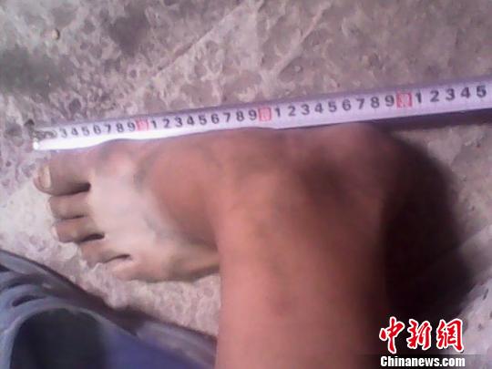 江西一15岁少年拥有54码大脚 已数月未穿鞋