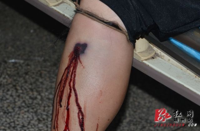 五步蛇咬伤农妇 怀化市二院紧急救治脱险_资讯频道_凤凰网