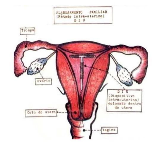 揭秘女性上环全过程(组图)