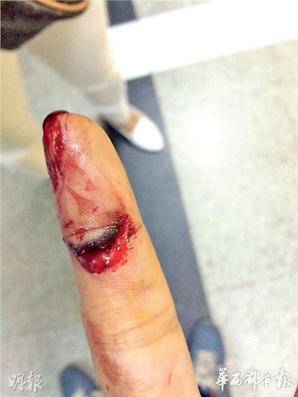 港媒狗咬狗变人咬人狗主人惨遭邻居咬破手指