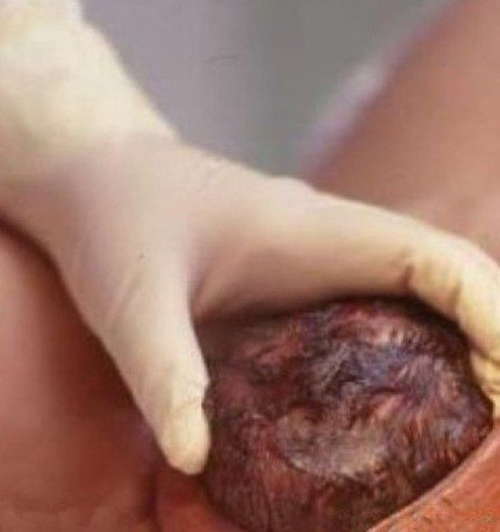 女人分娩顺产 实拍图片