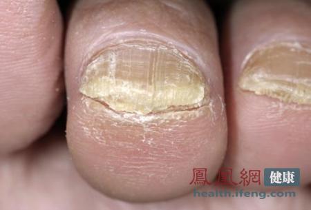 从脚看健康 脚趾透露癌症信号 - 雷石 - ☆★雷石