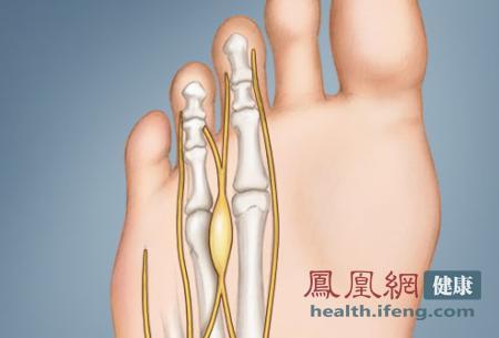 从脚看健康 脚趾透露癌症信号 - 雷石 - ☆★雷石